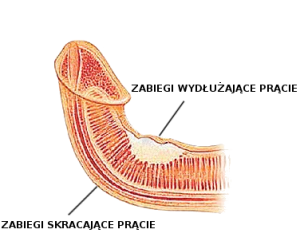 skrzywienie penisa, choroba Peyroniego