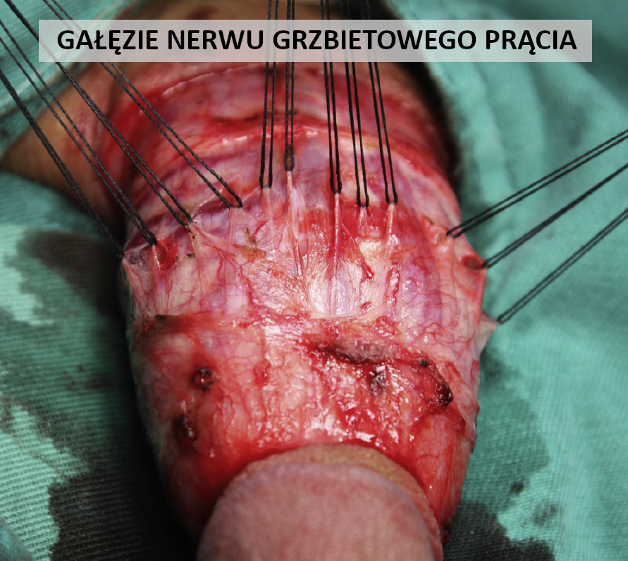 Mikrochirurgiczna denerwacja prącia. Mikrochirurgiczna neurotomia prącia.